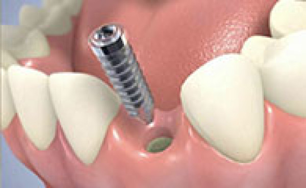 IMPLANTS DENTAIRES